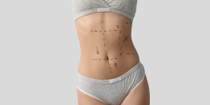 Cost-Effective Abdominoplasty Solutions Near Alexandria VA