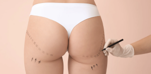 Liposuction and Tummy Tuck Procedure in High-Income Areas of Northern Virginia