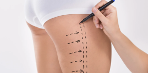 Liposuction Cost in Fairfax Virginia