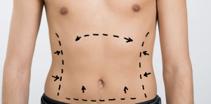 Liposuction Recovery and Cost Expectations in Reston Virginia