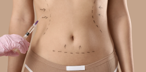Liposuction Cost and Consultation Availability in Arlington Virginia