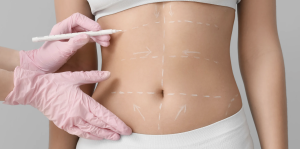 Tummy Tuck Surgery Cost Near McLean VA