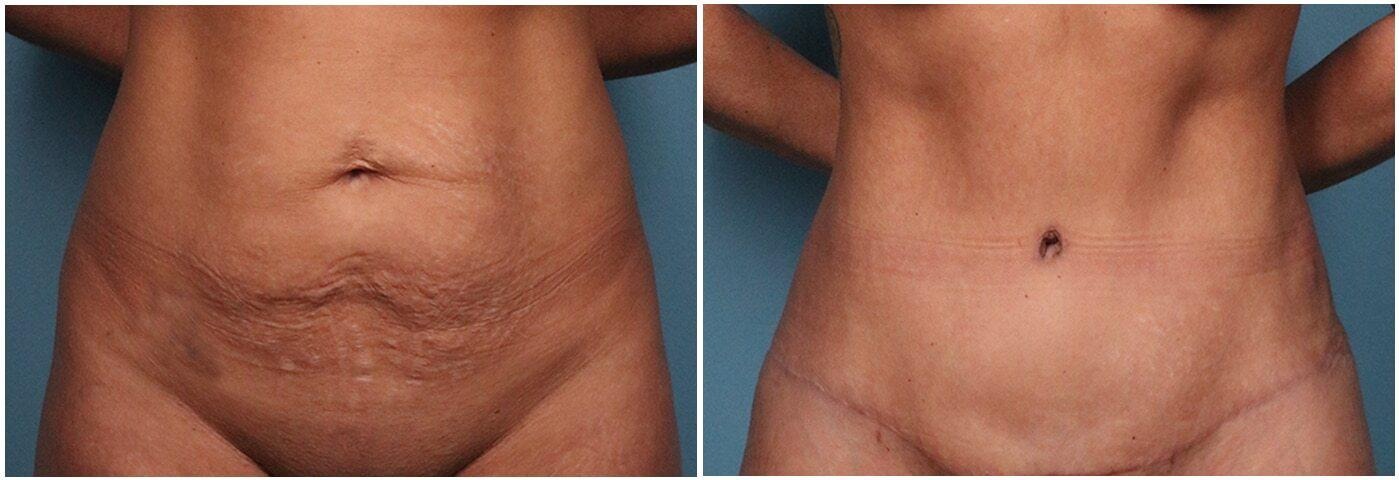 tummy tuck surgery