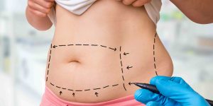 Liposuction Treatment Pricing for Stomach and Flanks in Maryland