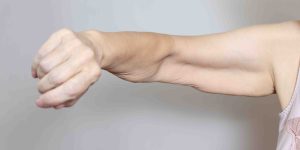 Surgery for Loose Skin After Weight Loss in Northern Virginia