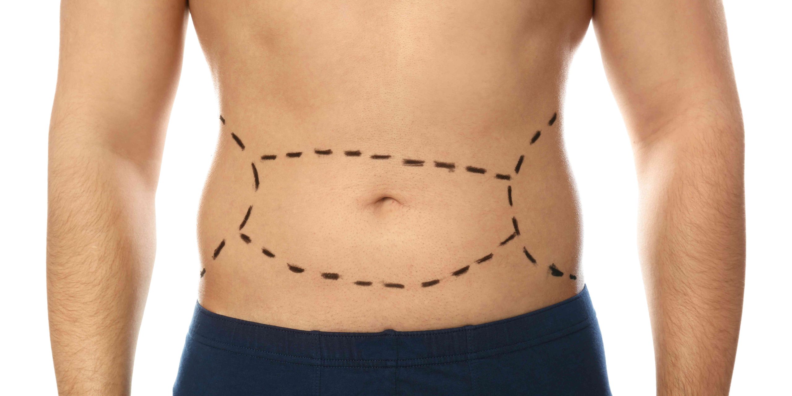 Tummy Tuck vs. Skin Tightening Surgery Pricing in Northern Virginia