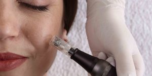 Microneedling Cost and Skin Rejuvenation Results in Northern Virginia
