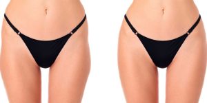 Hip Dip Correction Surgery in Northern Virginia
