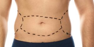 Tummy Tuck Surgery in Arlington Virginia