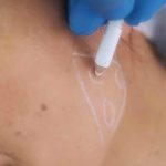 Dermal Fillers for Jawline and Cheek Enhancement