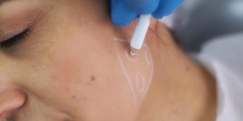 Dermal Fillers for Jawline and Cheek Enhancement