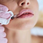 Lip Filler Consultations in Vienna VA