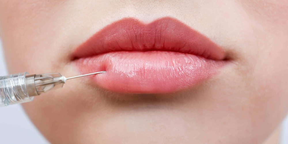 Lip Filler Appointments in Vienna VA