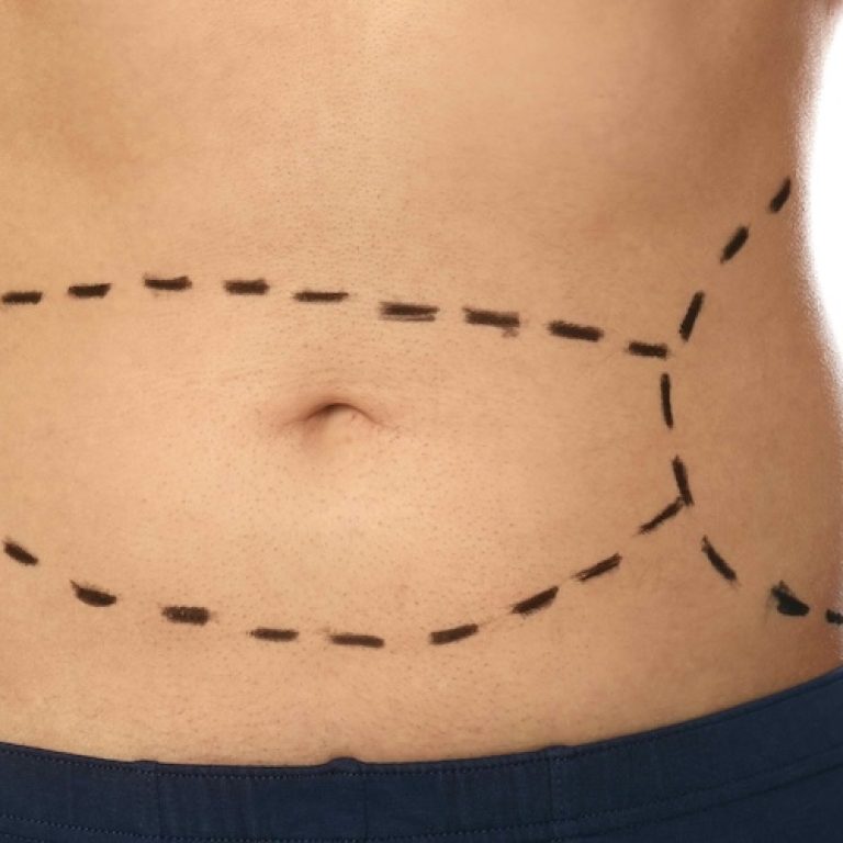Tummy Tuck Surgery in Arlington Virginia
