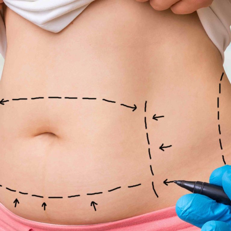 Liposuction Treatment Pricing for Stomach and Flanks in Maryland
