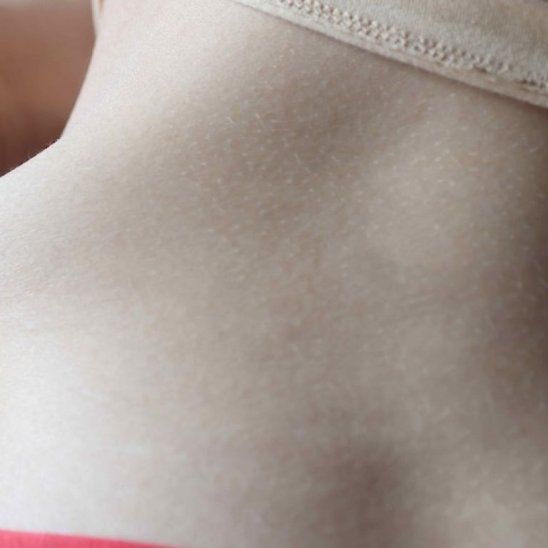 High-Definition Liposuction Surgery in Northern Virginia