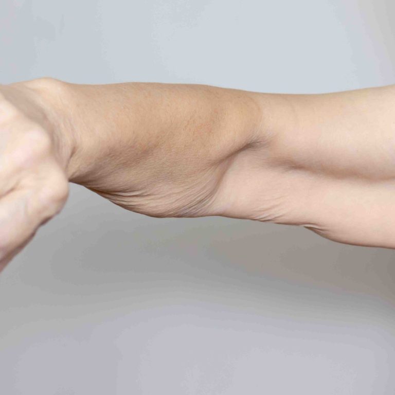 Surgery for Loose Skin After Weight Loss in Northern Virginia