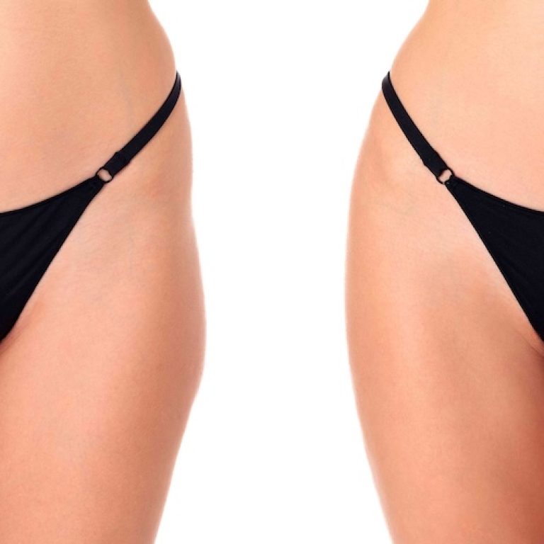 Hip Dip Correction Surgery in Northern Virginia