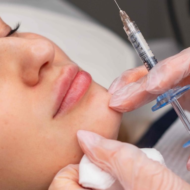 Lip Filler In Vienna VA