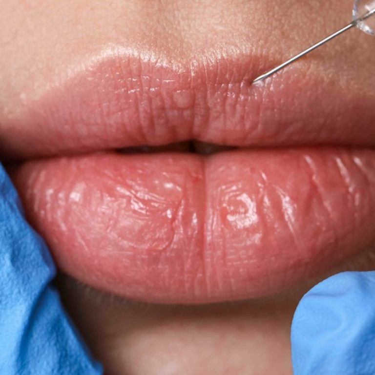 Lip Filler Prices in Northern Virginia