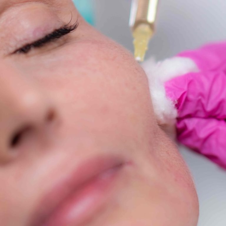 Cheek Filler Near McLean VA