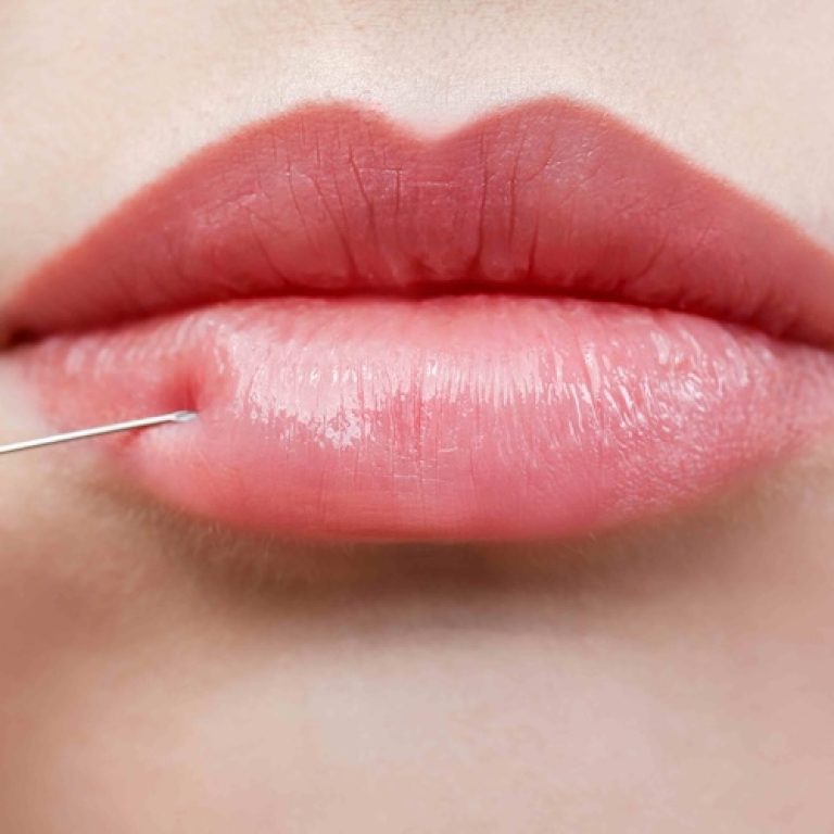 Lip Filler Appointments in Vienna VA