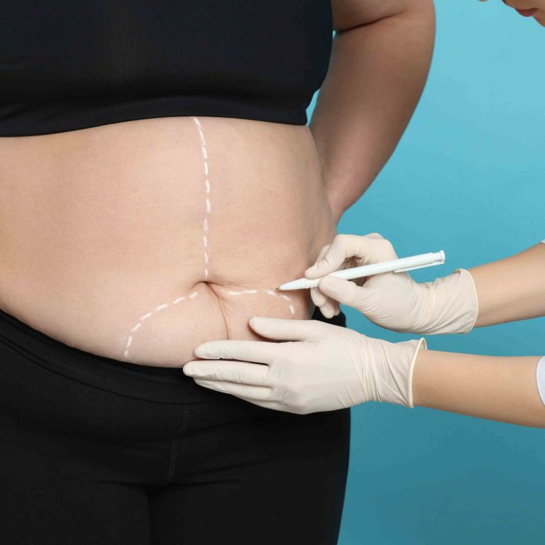 Best Tummy Tuck Prices and Types Near Woodbridge VA