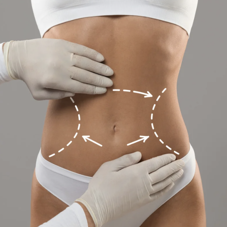 Best Liposuction Surgery Results in McLean