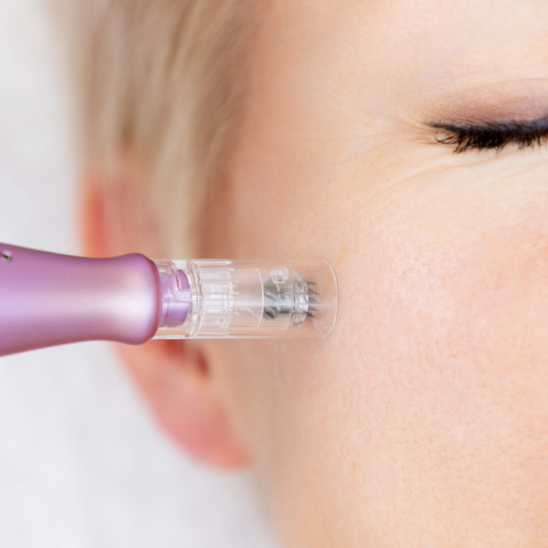RF Microneedling In Vienna