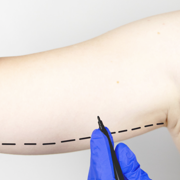 Liposuction Cost in Annandale