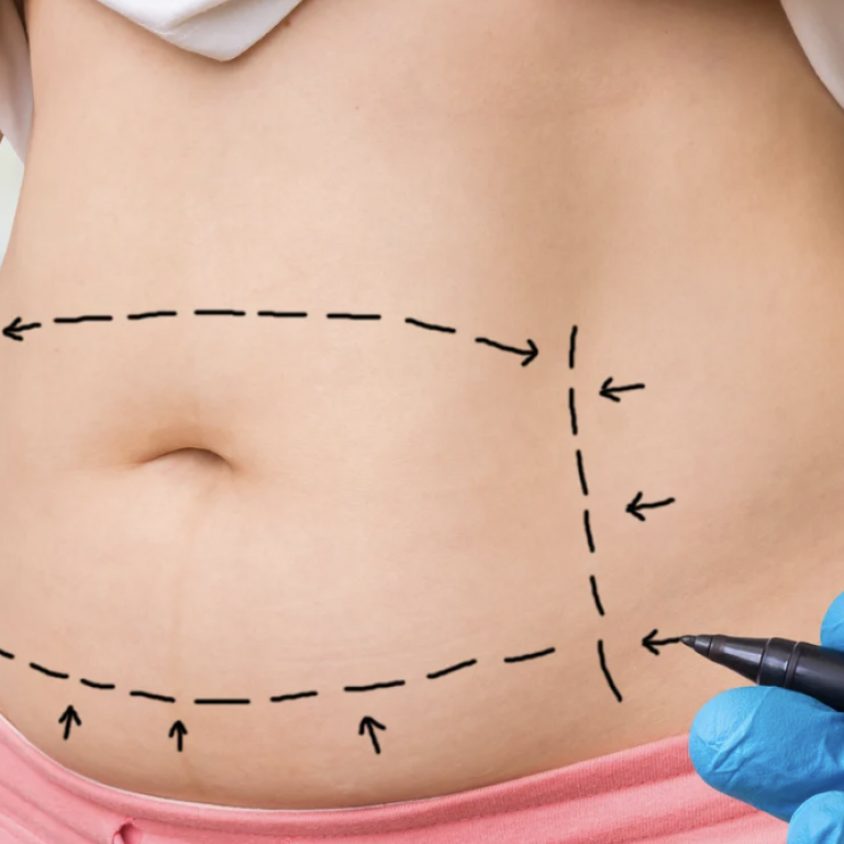 Liposuction Cost Near Annandale