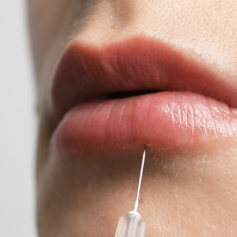 Best Lip Filler injections in Vienna