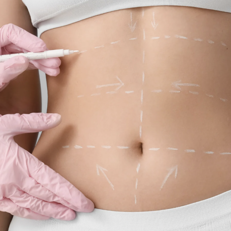 Tummy Tuck Costs in Northern Virginia