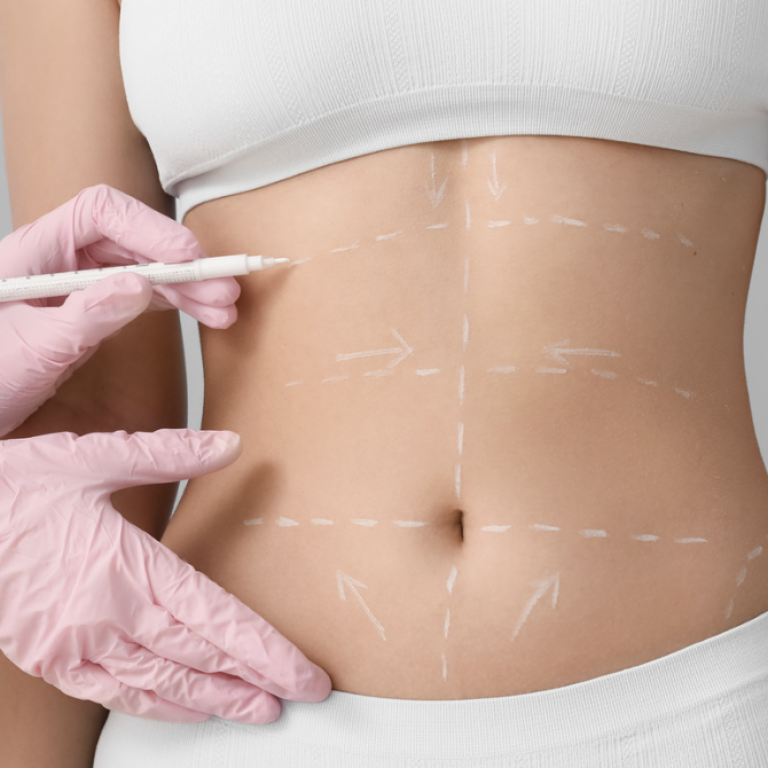 Liposuction Surgeon and Costs in Alexandria