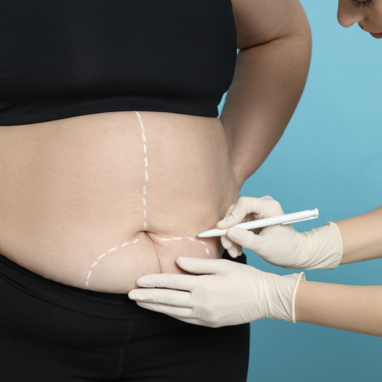 360 Liposuction Surgery Provider and Cost