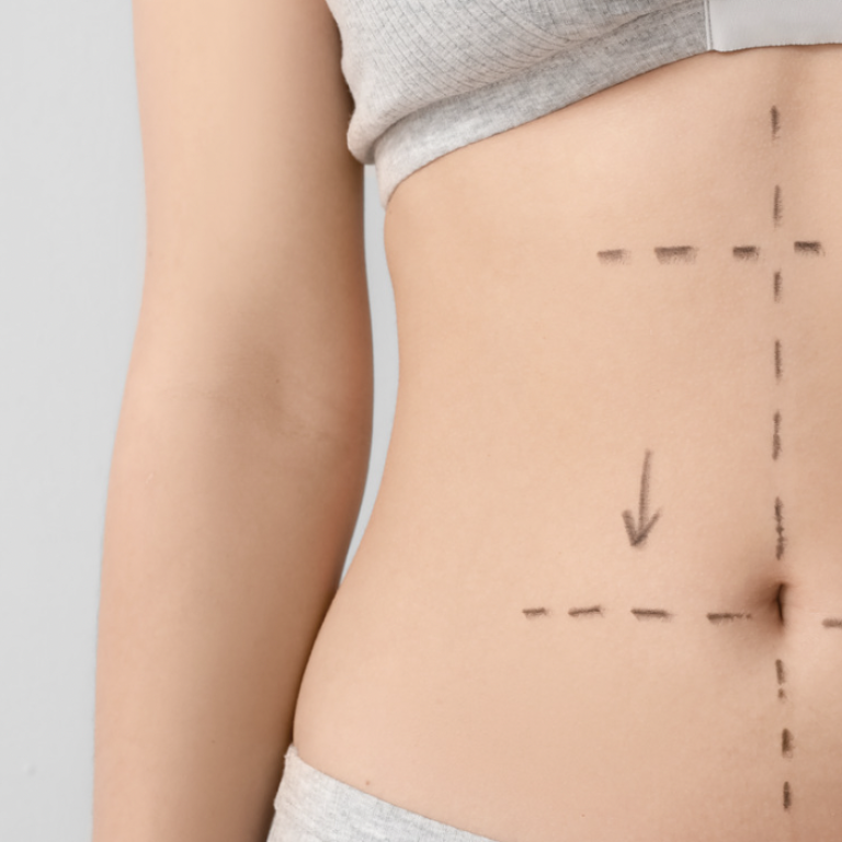 Affordable Liposuction Clinic in Arlington