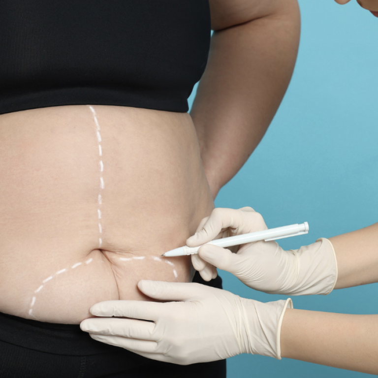 Cost-Effective Liposuction Options Available in Fairfax