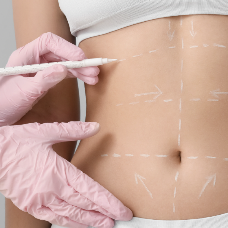Liposuction Treatments for Residents of Richmond Virginia