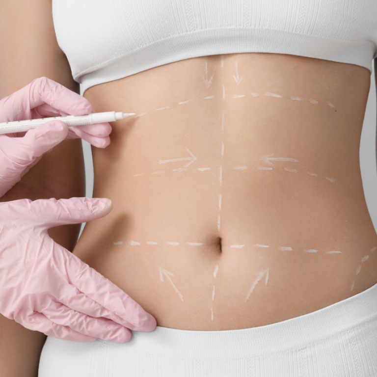 Liposuction Surgery in Reston Virginia