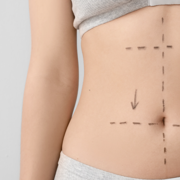 Affordable Liposuction Clinic Near Alexandria