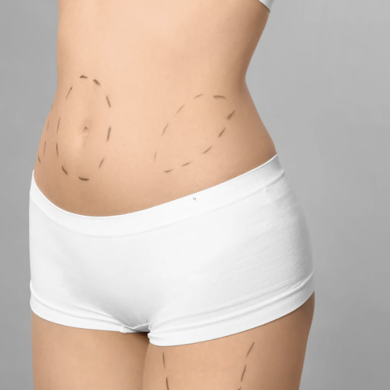 Affordable Liposuction Provider in Centreville