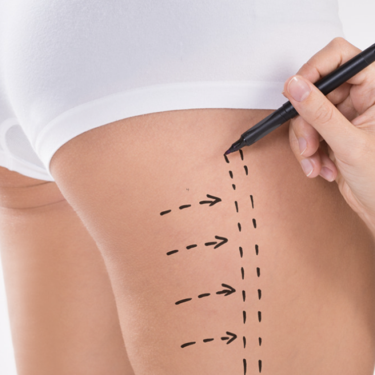 Liposuction Price Ranges in Reston VA