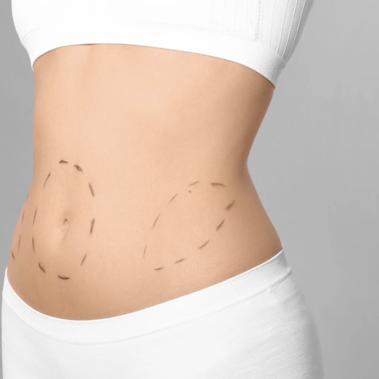 Liposuction Costs in Arlington VA