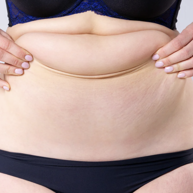 Liposuction and Tummy Tuck Surgery in Northern Virginia