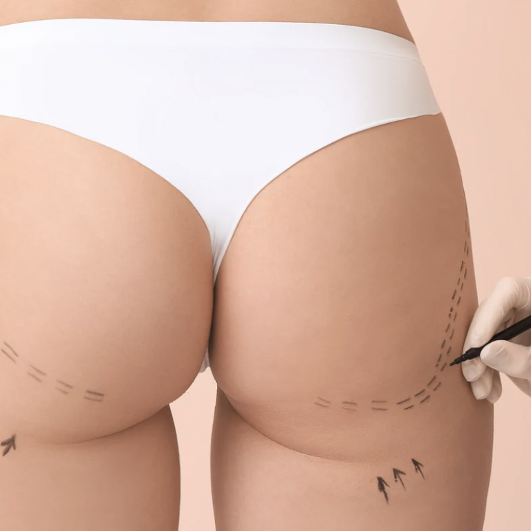 Liposuction and Tummy Tuck Procedure in High-Income Areas of Northern Virginia