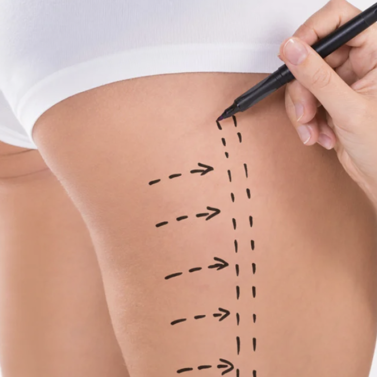 Liposuction Cost in Fairfax Virginia