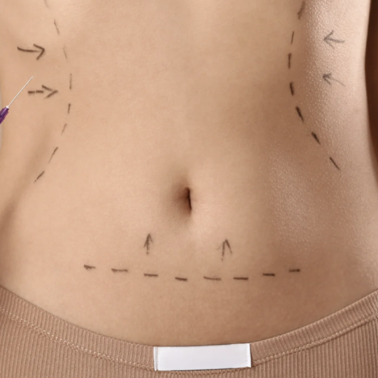 Liposuction Cost and Consultation Availability in Arlington Virginia