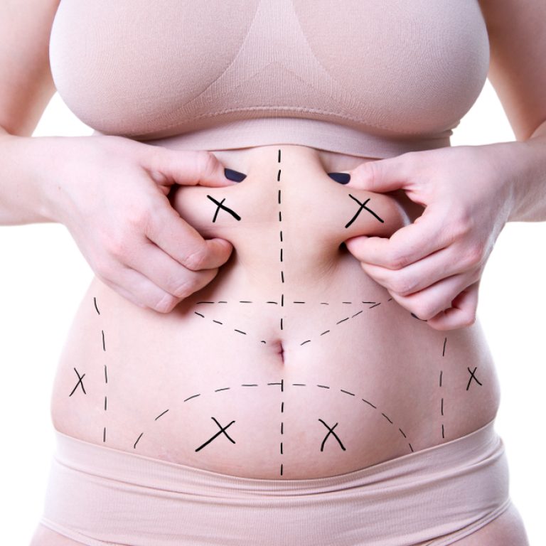 Liposuction Specialist