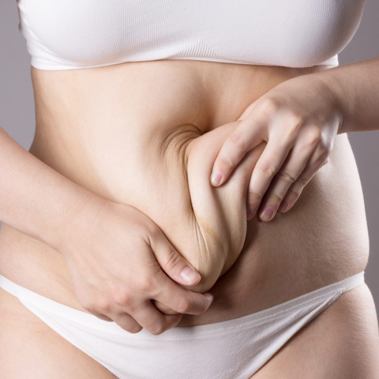 Tummy Tuck Consultation in McLean