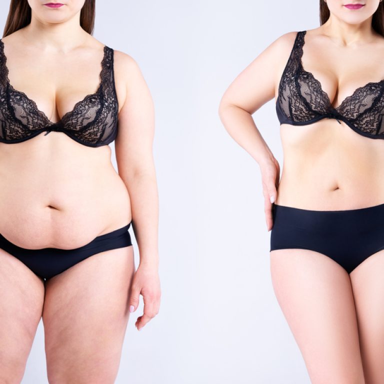 Best Tummy Tuck in Northern Virginia